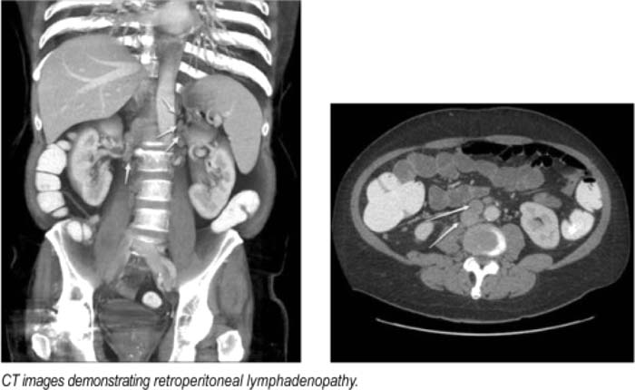 retroperitoneal lymph nodes