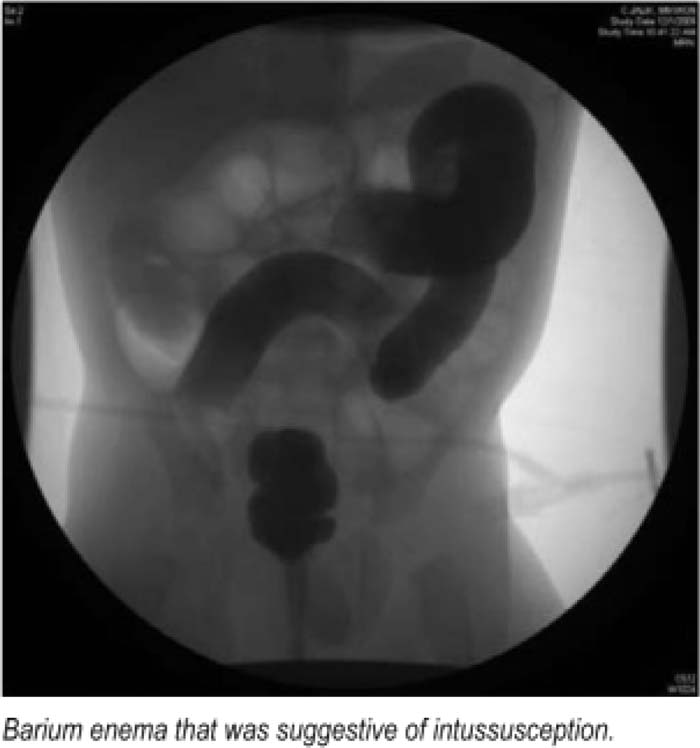 intussusception x ray