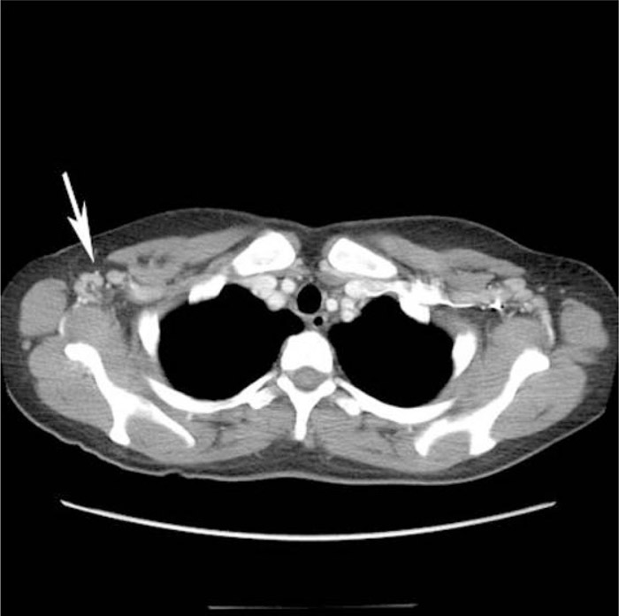 shotty bilateral axillary lymph nodes