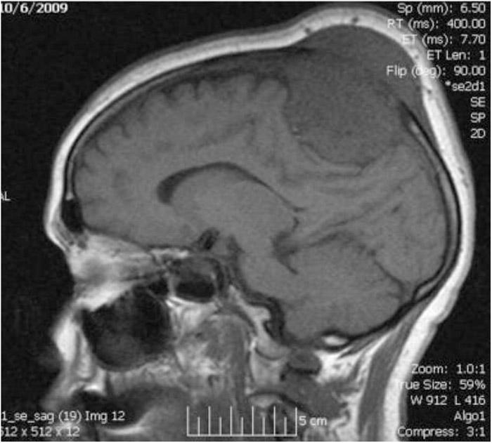 Adenocarcinoma Of The Lung Presenting As A Skull Mass Shm Abstracts