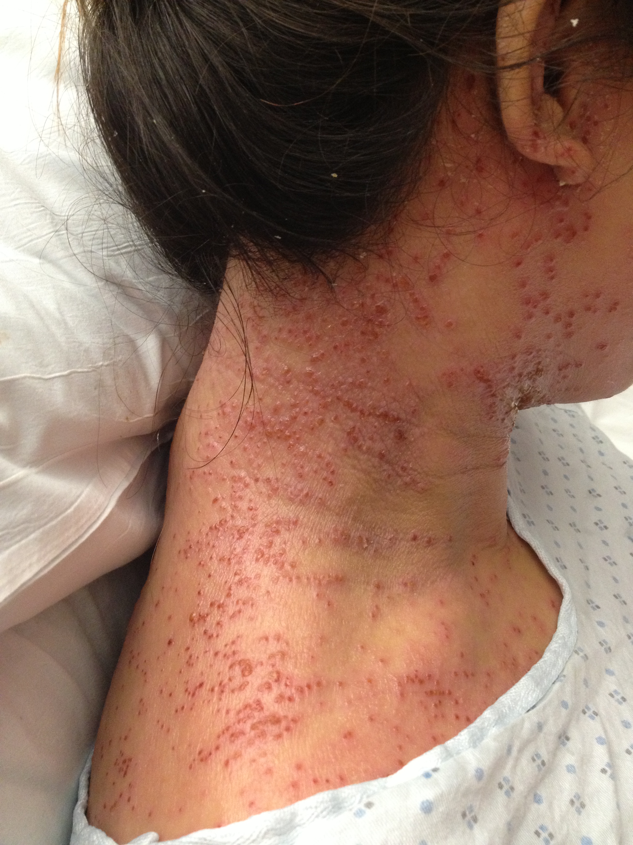 amlodipine pinpoint rash