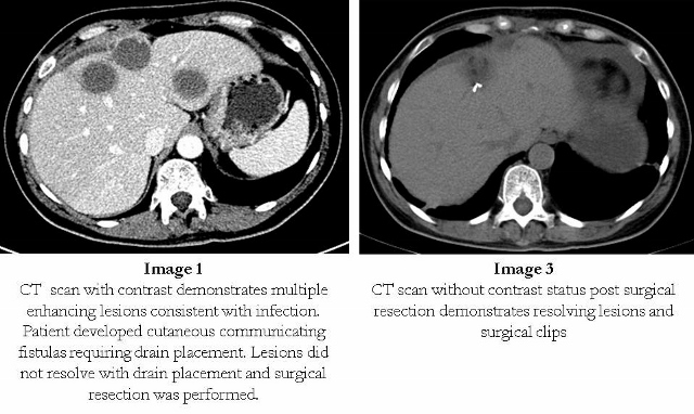 sepsis-with-transaminitis-more-than-shock-liver-shm-abstracts