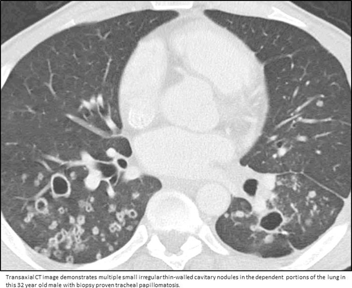 Papillomatosis lung ct, Laryngeal papillomatosis in neonates