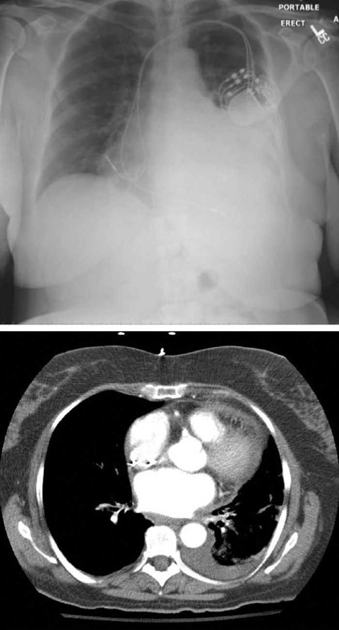 pertinent-problems-after-pacemaker-placement-shm-abstracts-society