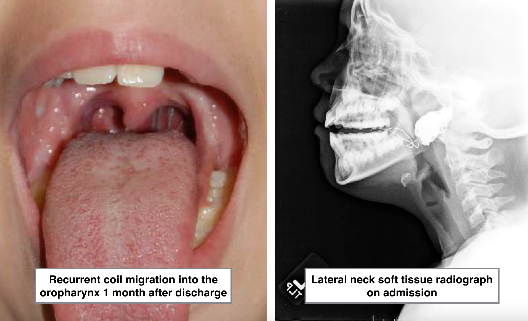 Uncoiling A Problematic Tickle In The Throat SHM Abstracts