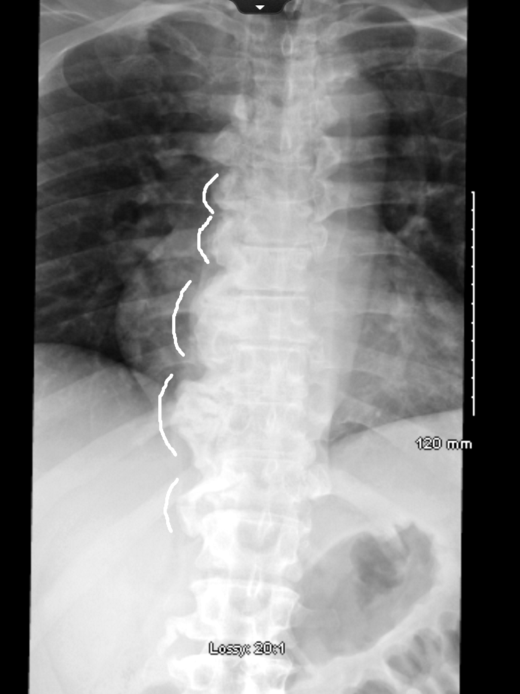 diffuse idiopathic skeletal hyperostosis cervical spine