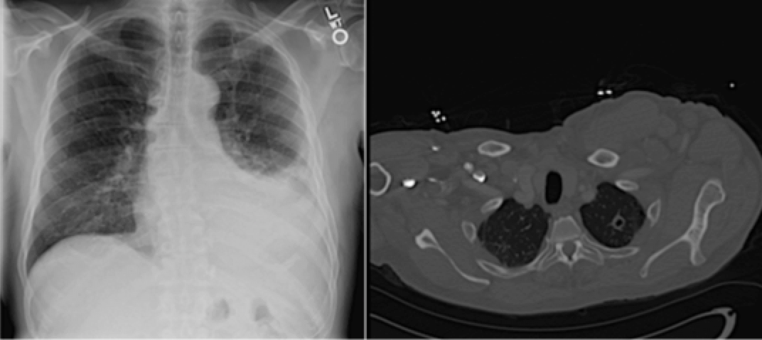 An Atypical Presentation Of Extrapulmonary Pleural Tuberculosis Shm