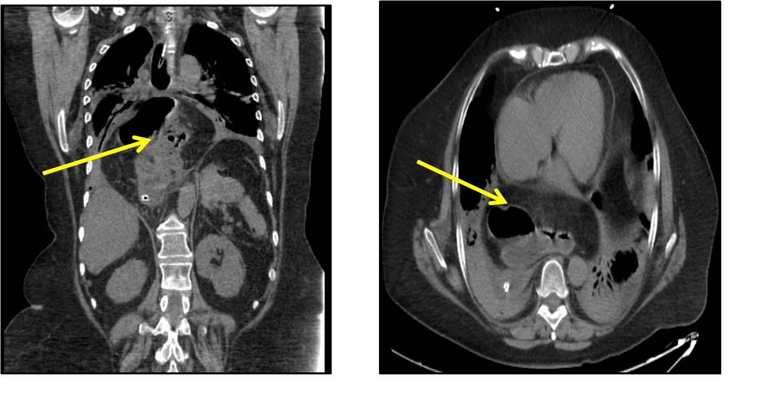 paraesophageal hernia with gastric volvulus