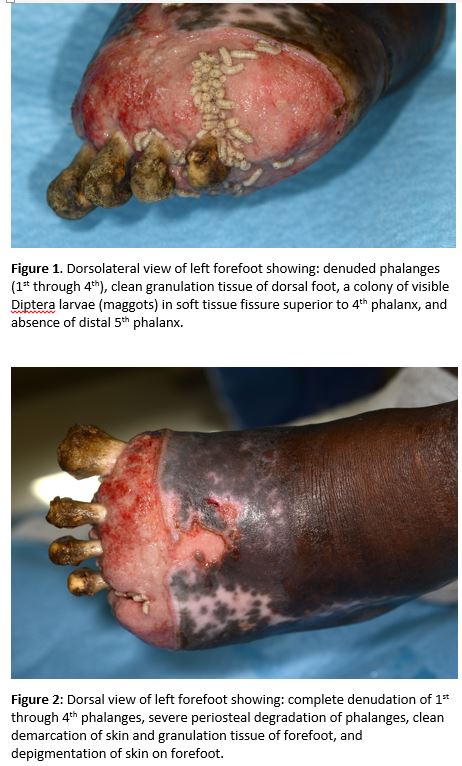 Worked to the Bone: A Severe Unusual Case of Wound Myiasis - SHM Abstracts