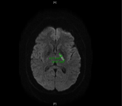 Effects Of Phentermine On The Brain