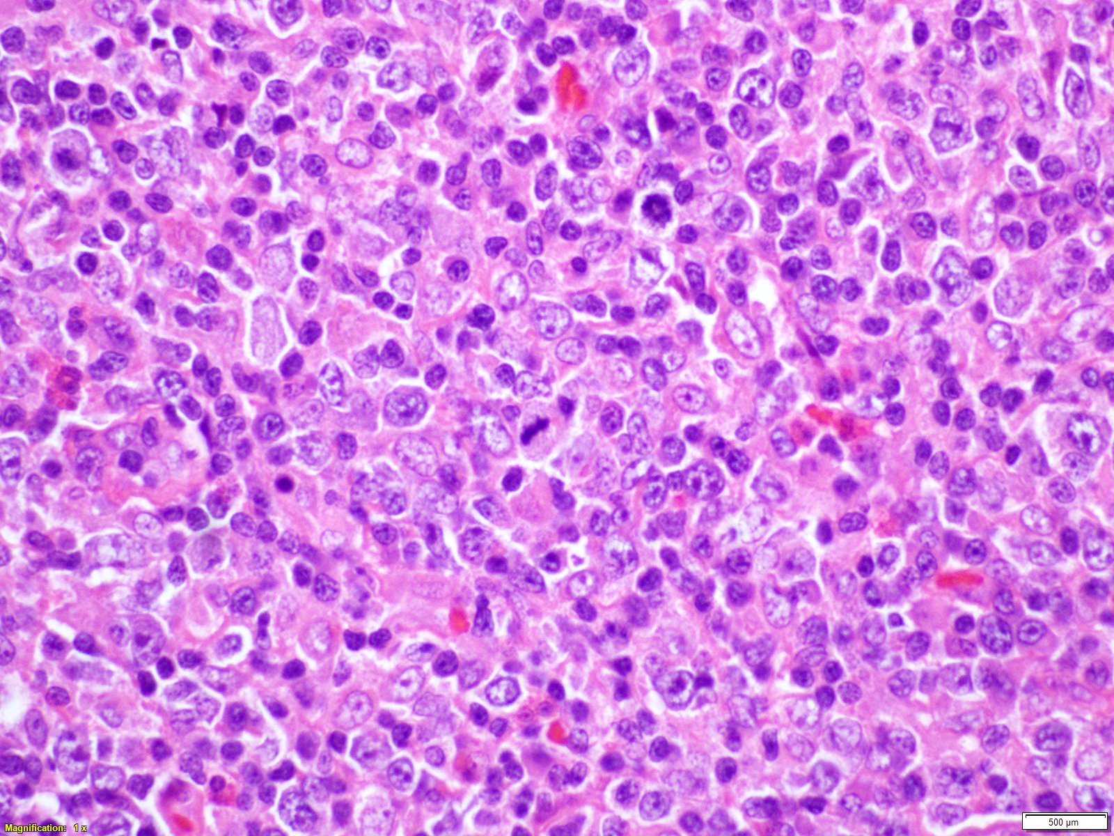 A Rare Case of Angioimmunoblastic TCell Lymphoma Abstracts